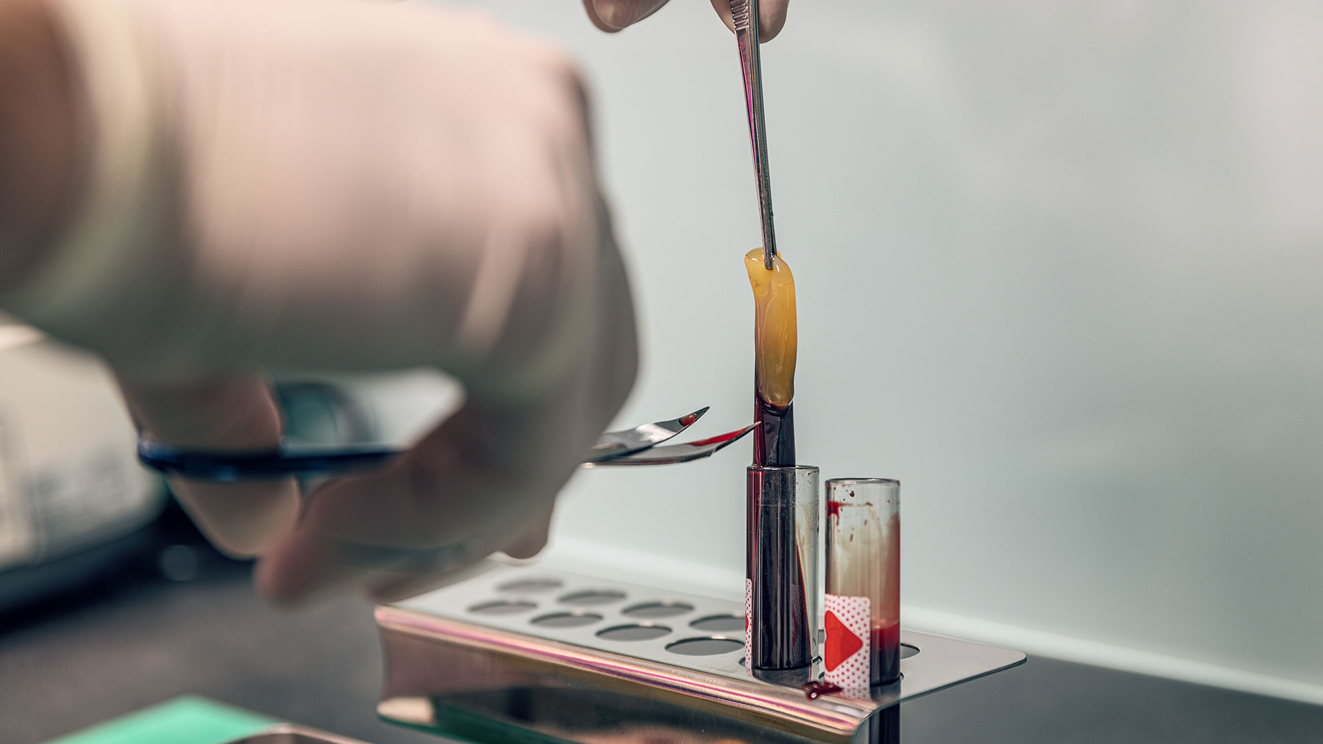 PRF therapy platelet rich fibrin extraction process