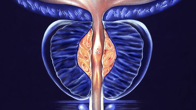 Ozone Prostate Injection Therapy image of prostate