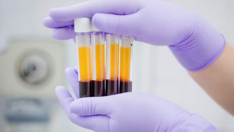 Platelet Rich Fibrin PRF prepared from patient blood for regenerative pain relief treatment